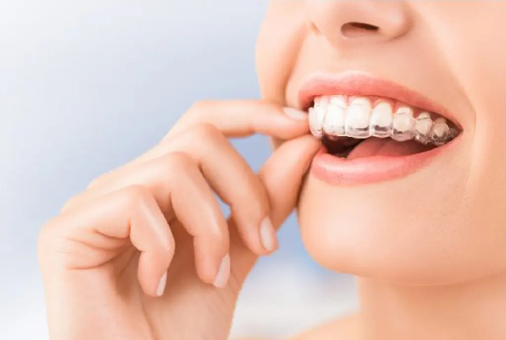 Niềng Răng Invisalign