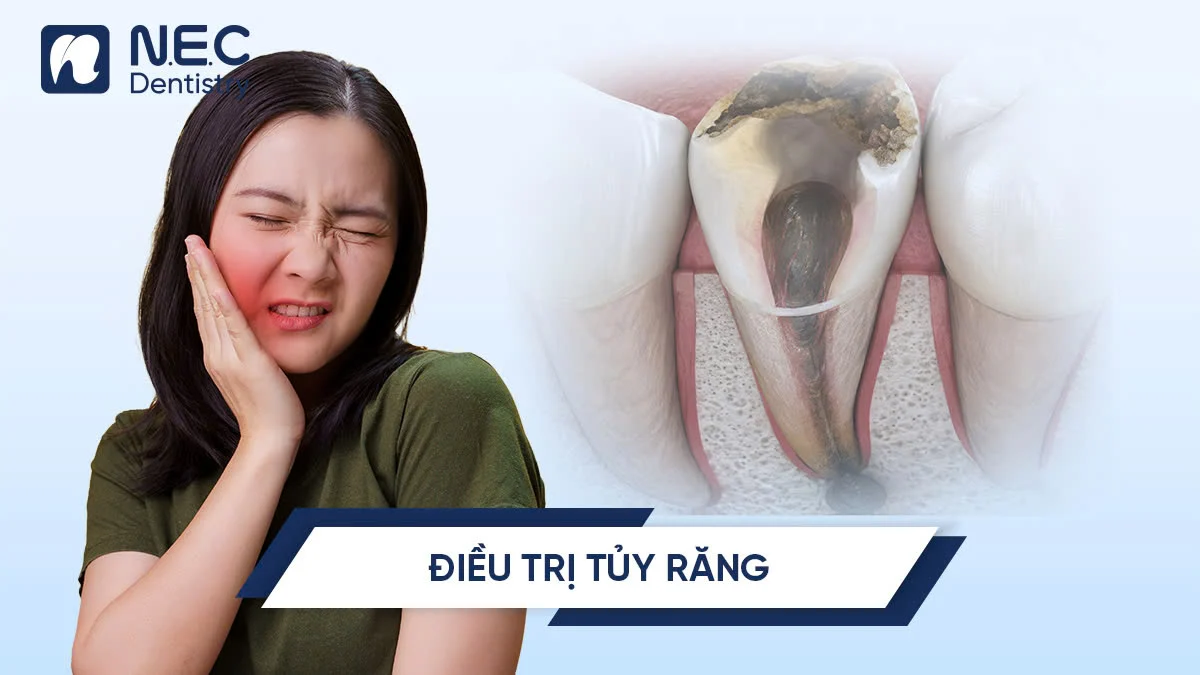 Điều trị tủy răng: Quy trình và khi nào cần điều trị