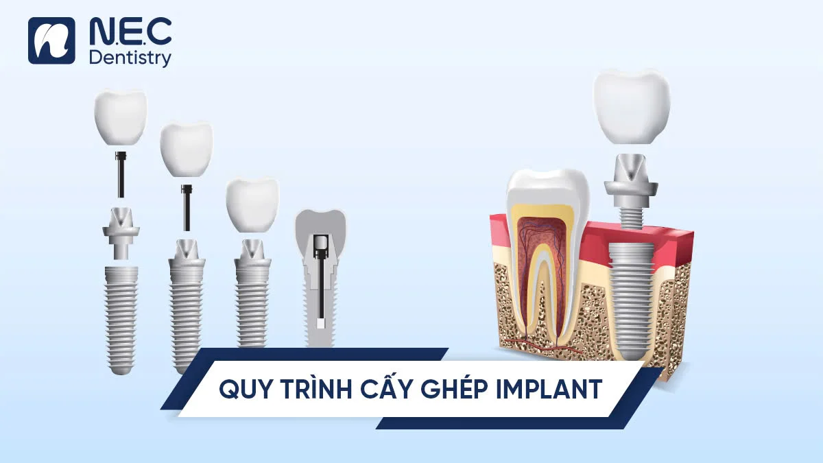 8 Bước trong quy trình cấy ghép implant